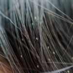 How Long Do Lice Eggs Take to Hatch