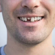 how to fix a cracked tooth naturally