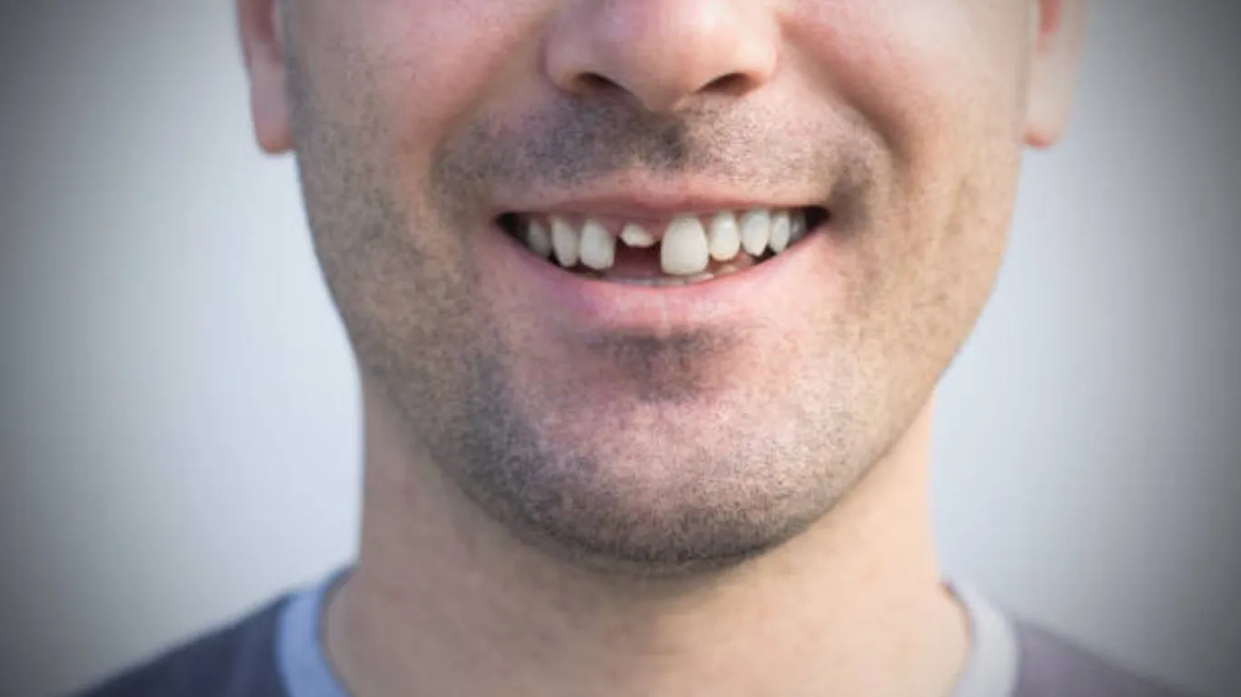 how to fix a cracked tooth naturally