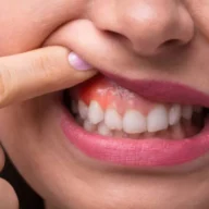 how to cure gum disease without a dentist