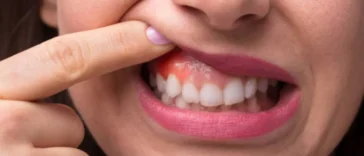 how to cure gum disease without a dentist