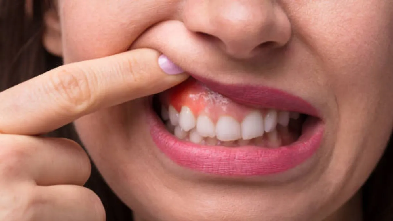how to cure gum disease without a dentist