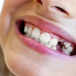 How to Extract a Broken Tooth at Home